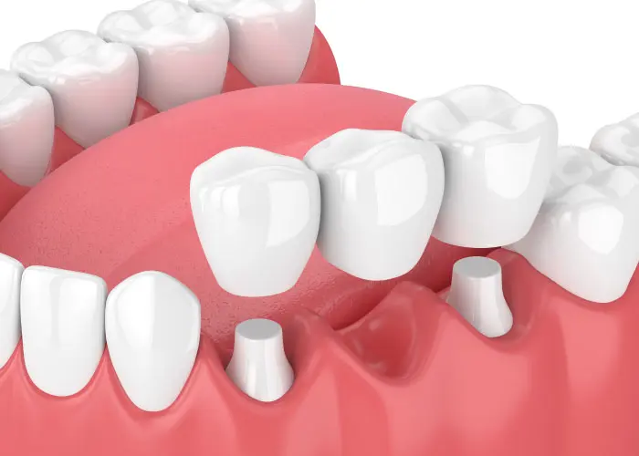 dental bridge and implant model