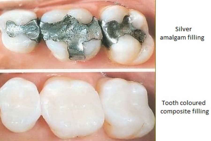 dental fillings comparing amalgam and composite materials