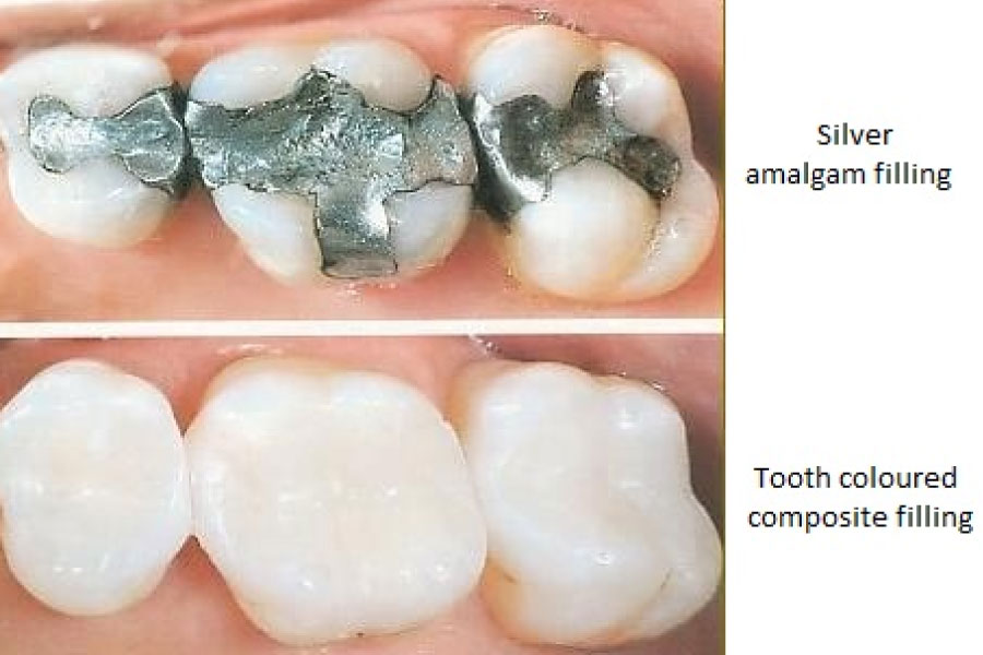 Dental Fillings